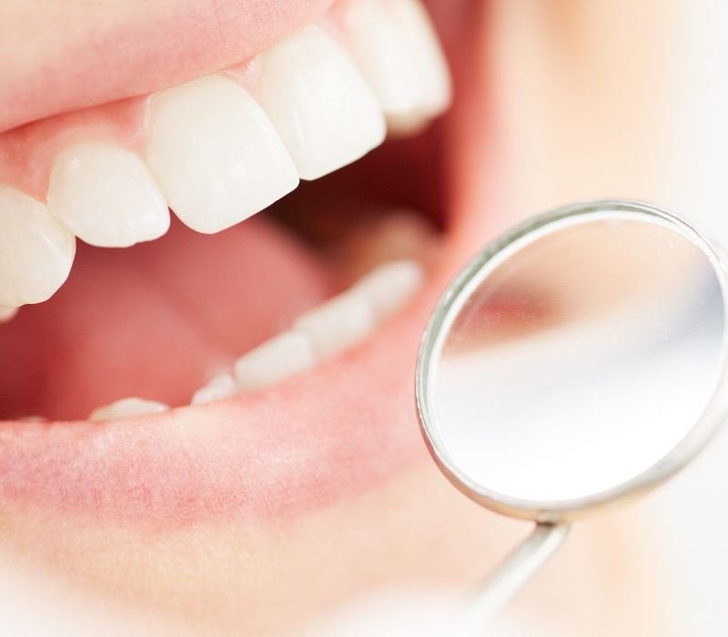 Implantes Dentales